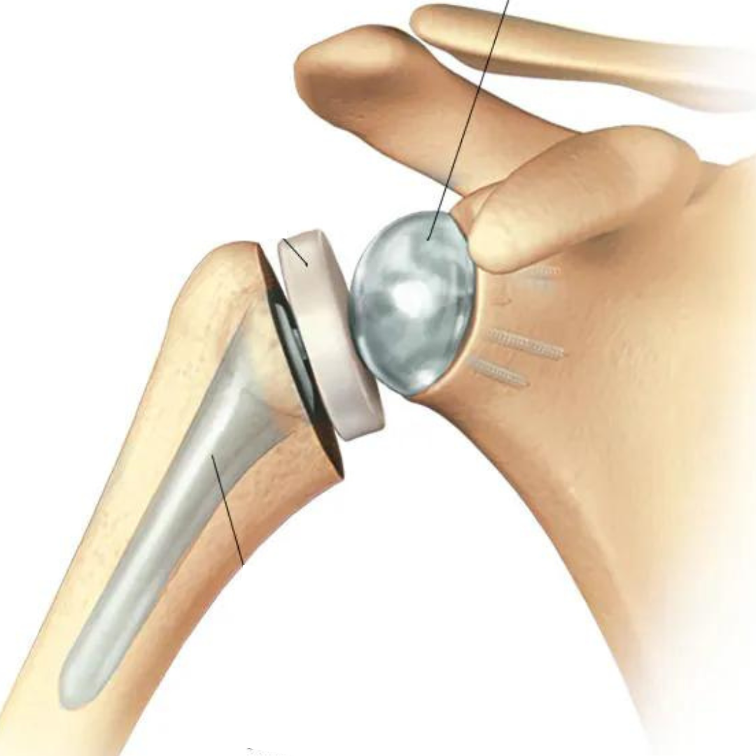 Total Shoulder Replacement Surgery Icon